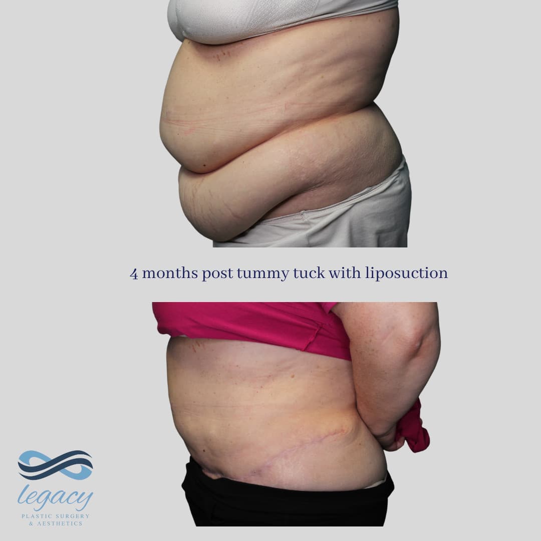Tummy Tuck (Abdominoplasty) - Penn Medicine Lancaster General Health